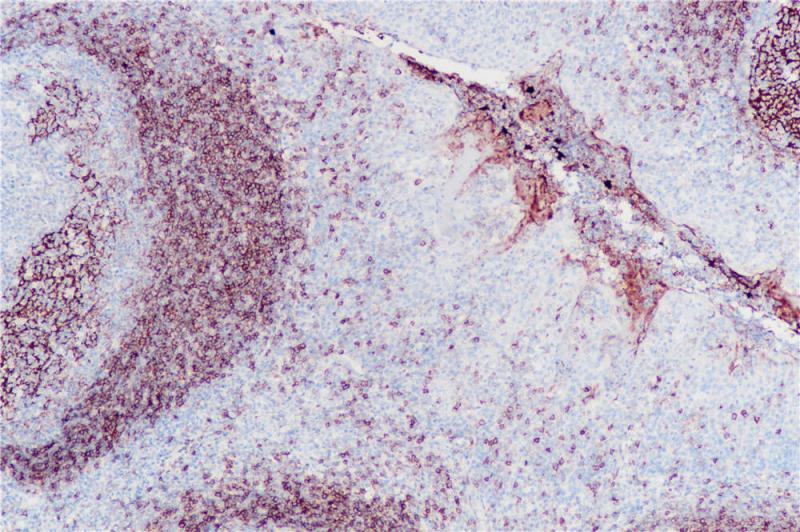 扁桃体 CD23 (BP6049) 染色