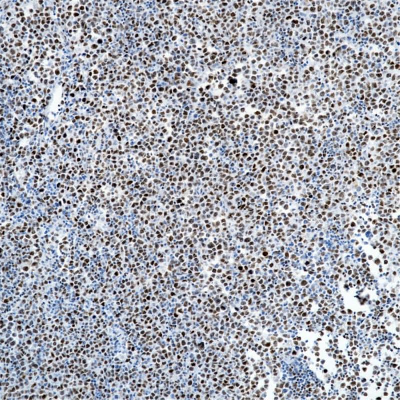 弥漫性大B细胞淋巴瘤 FOXP1 (BP6112) 染色