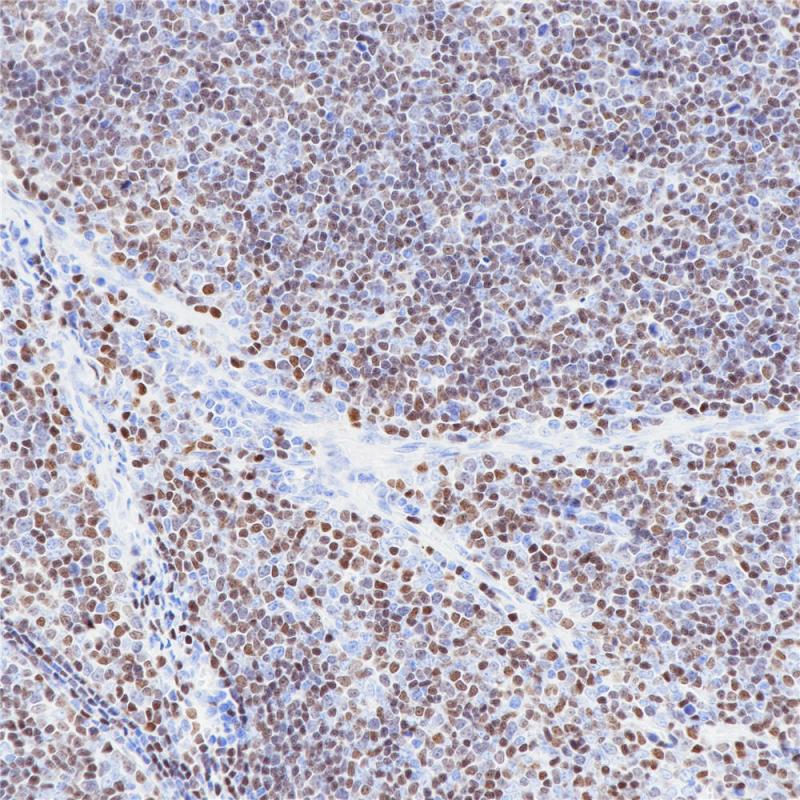 胸腺瘤 TdT (BP6089) 染色