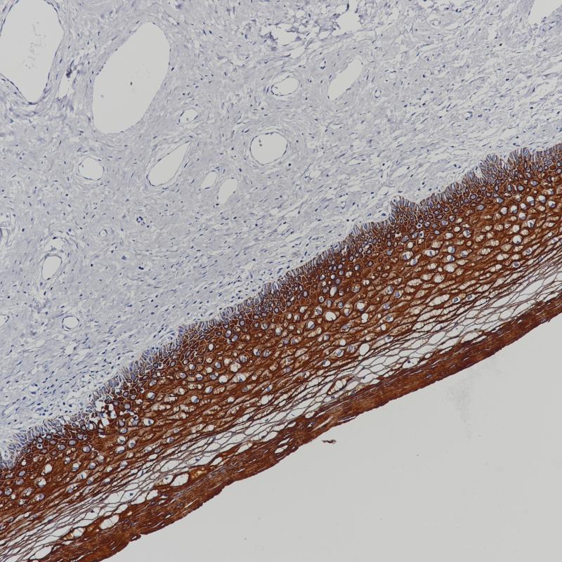 宫颈 CK 5&6 (BP6021&BP6065)染色.jpg