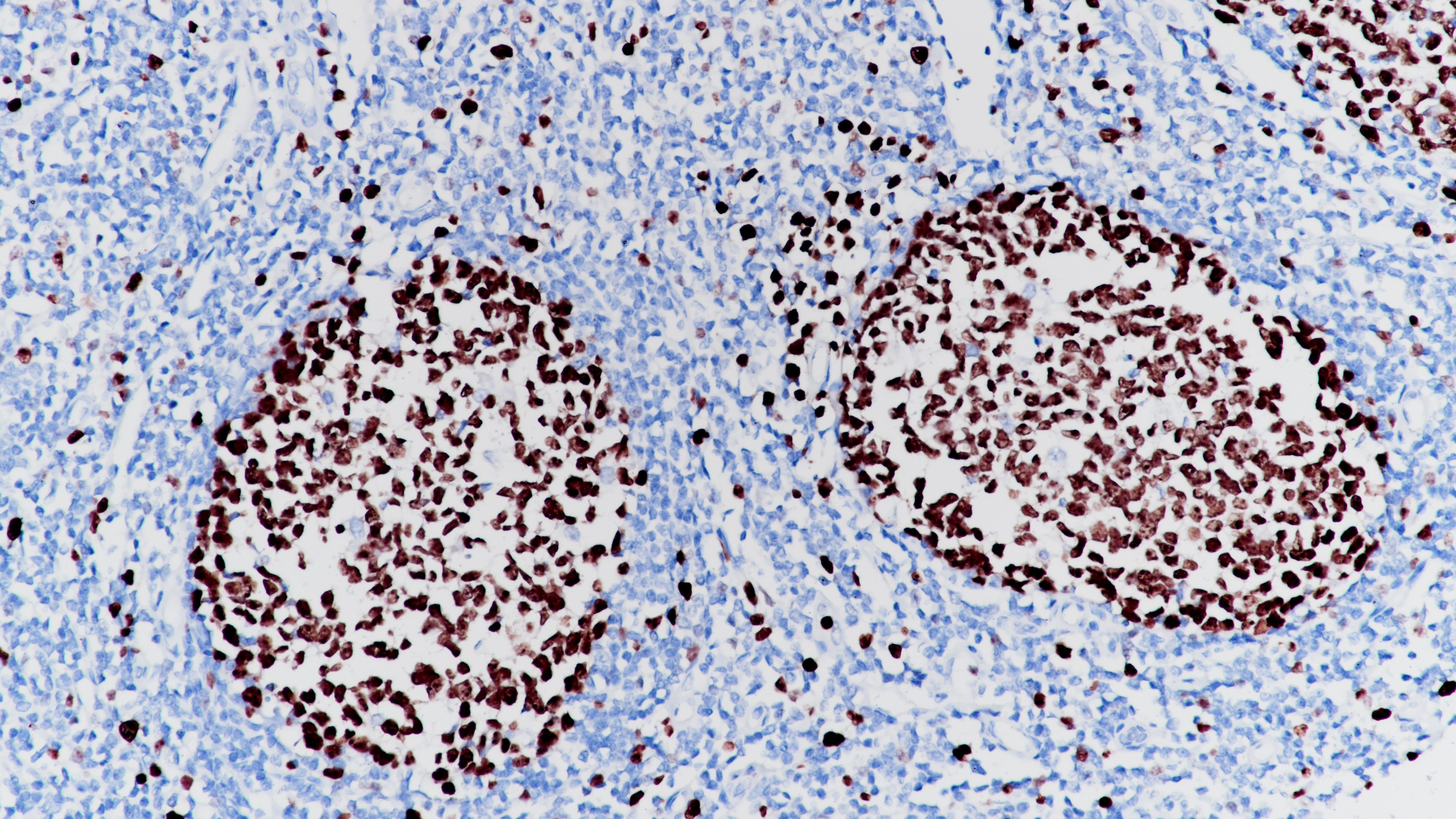 扁桃体Ki-67(BP6045)染色