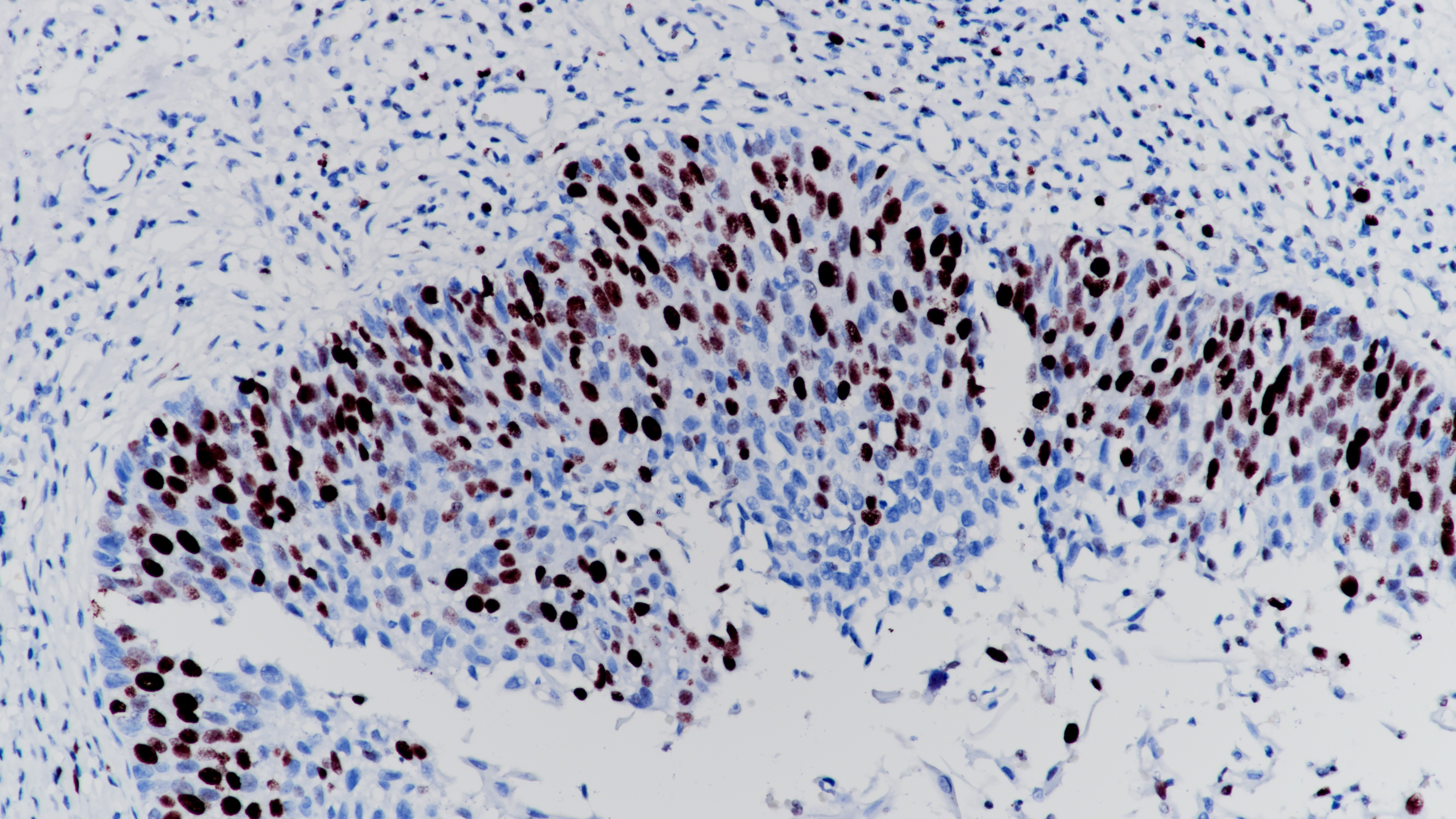 食管Ki-67(BP6045)染色