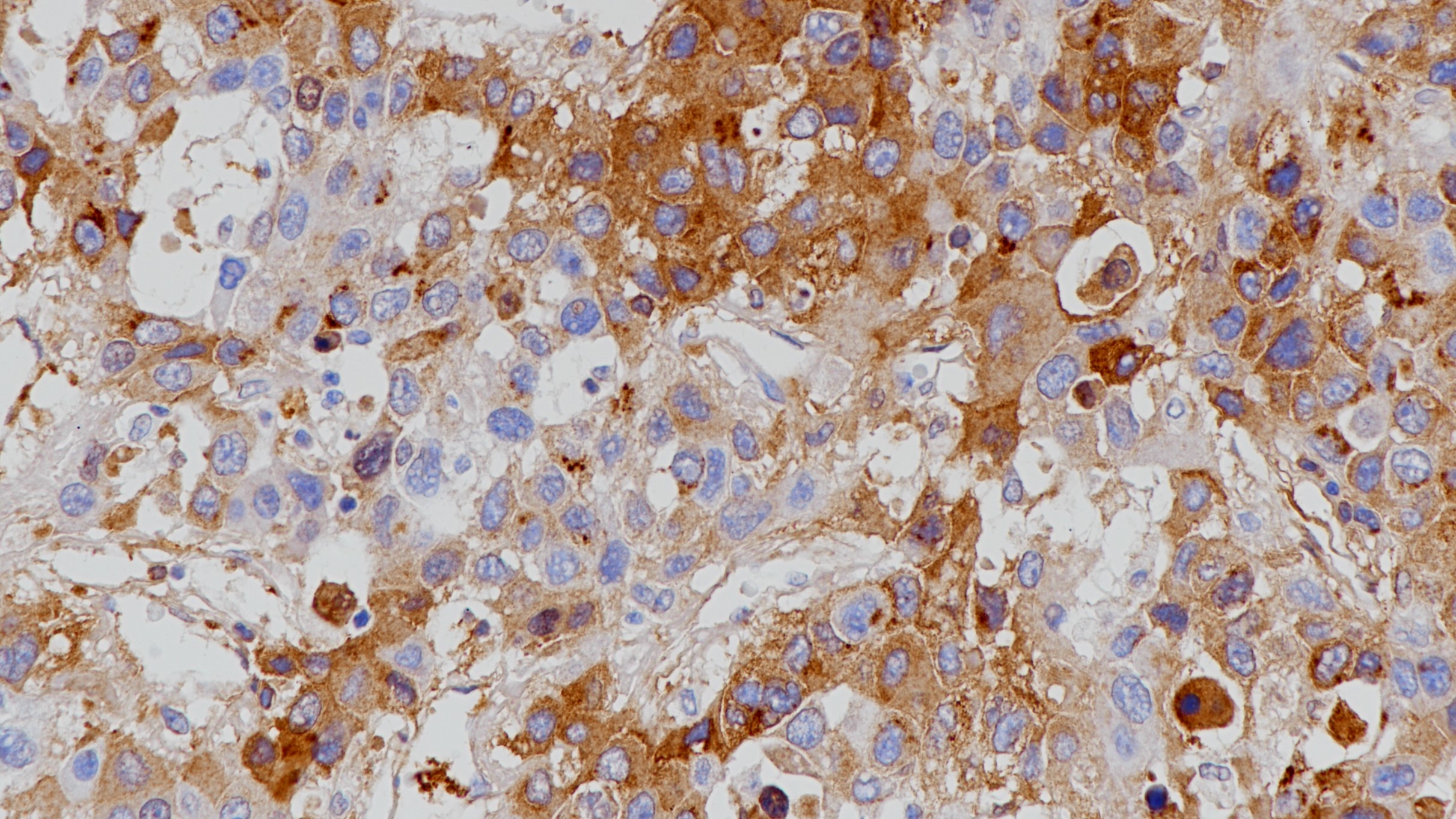 肝癌AFP(poly)染色