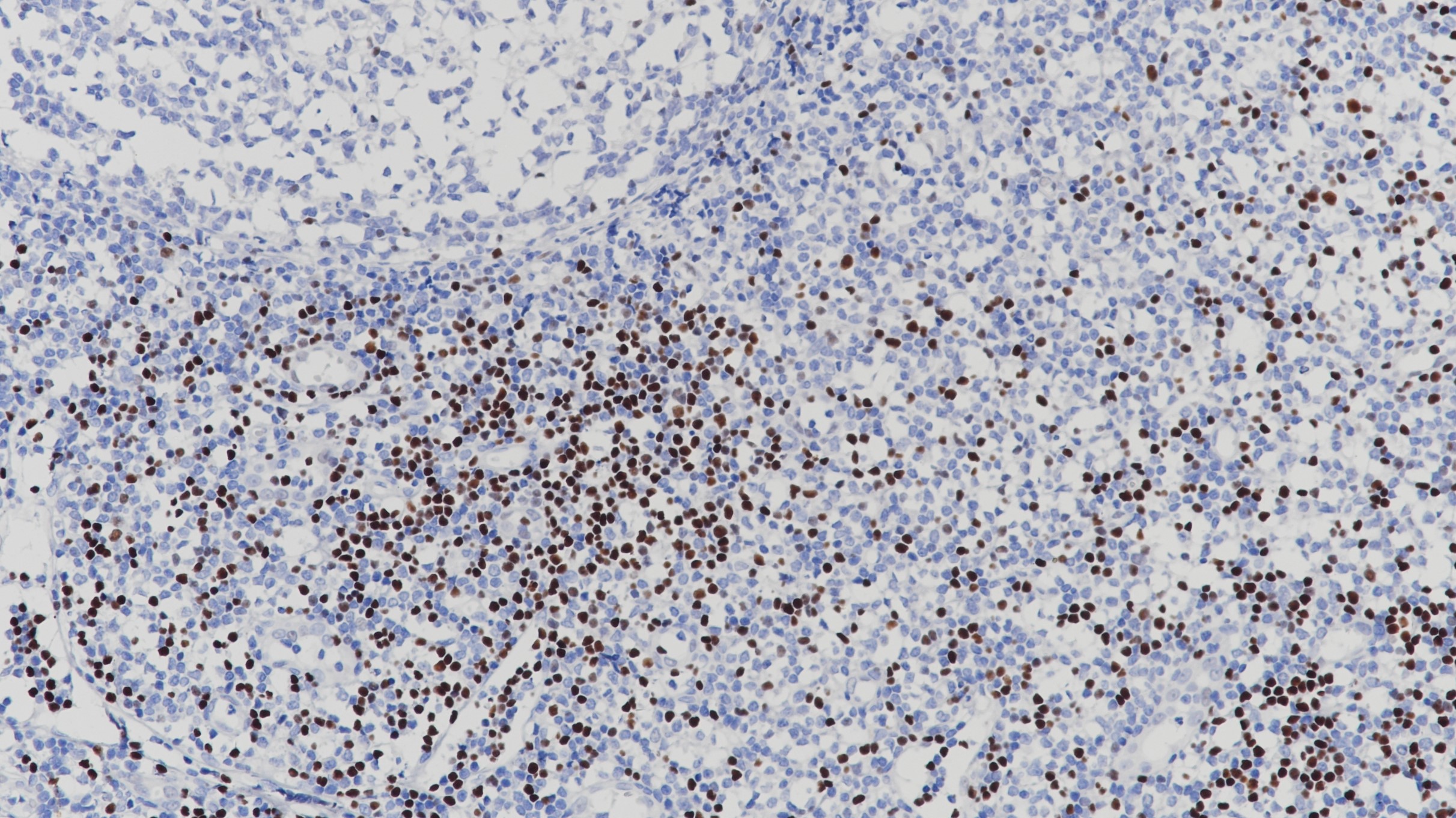 扁桃体LEF-1(BP6113)染色