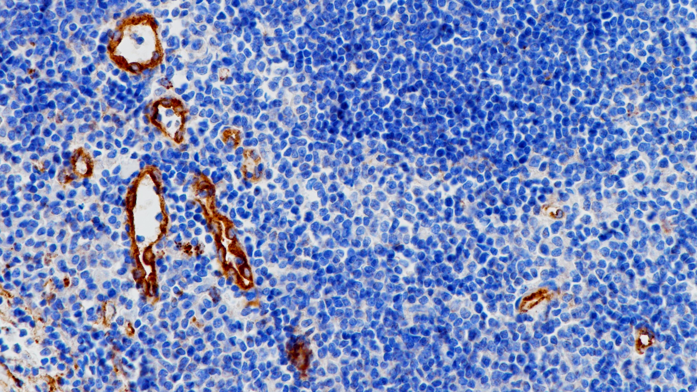 扁桃体Factor VIII (BP6084)染色