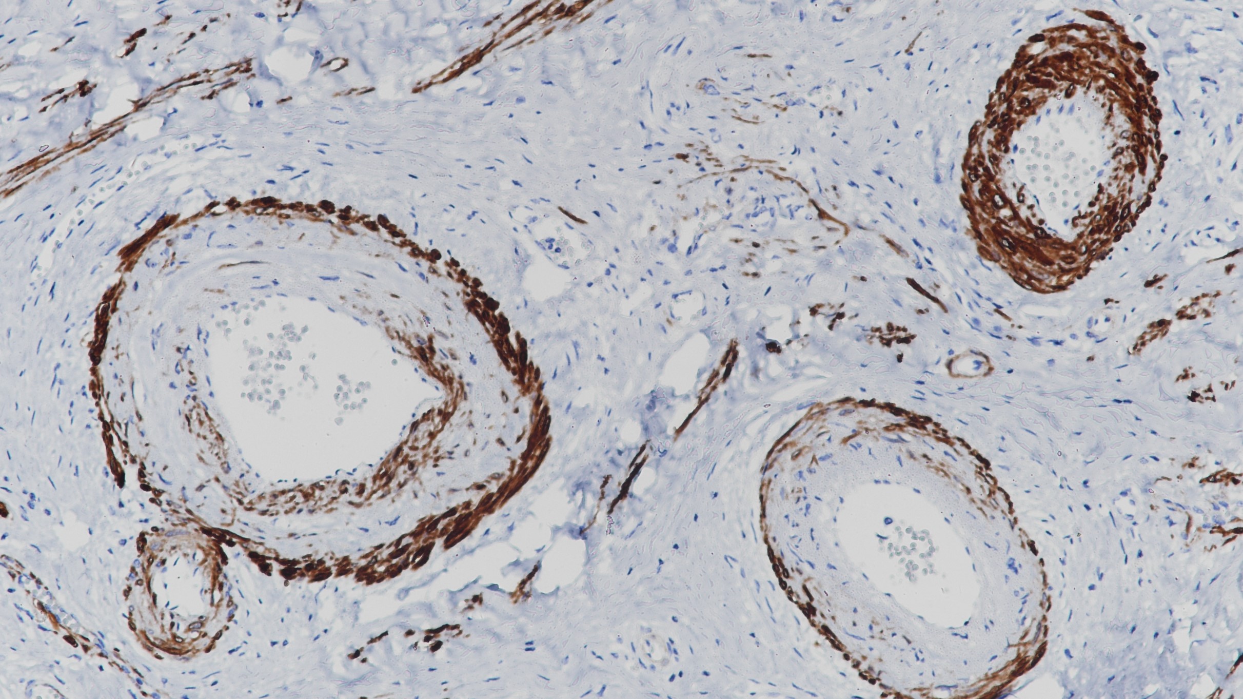 宫颈Calponin(BP6093)染色