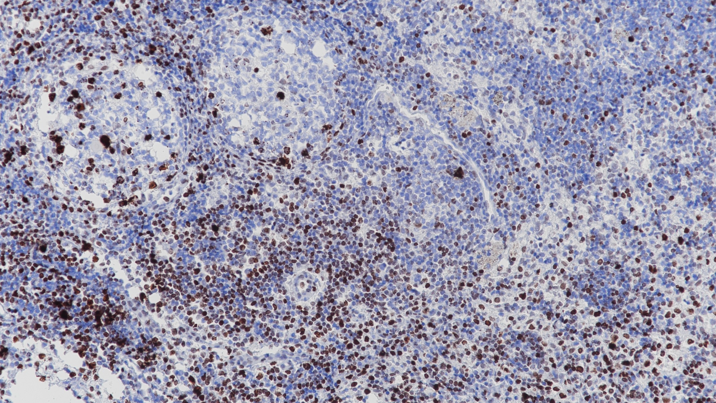 淋巴结PHH3(BP6092)染色