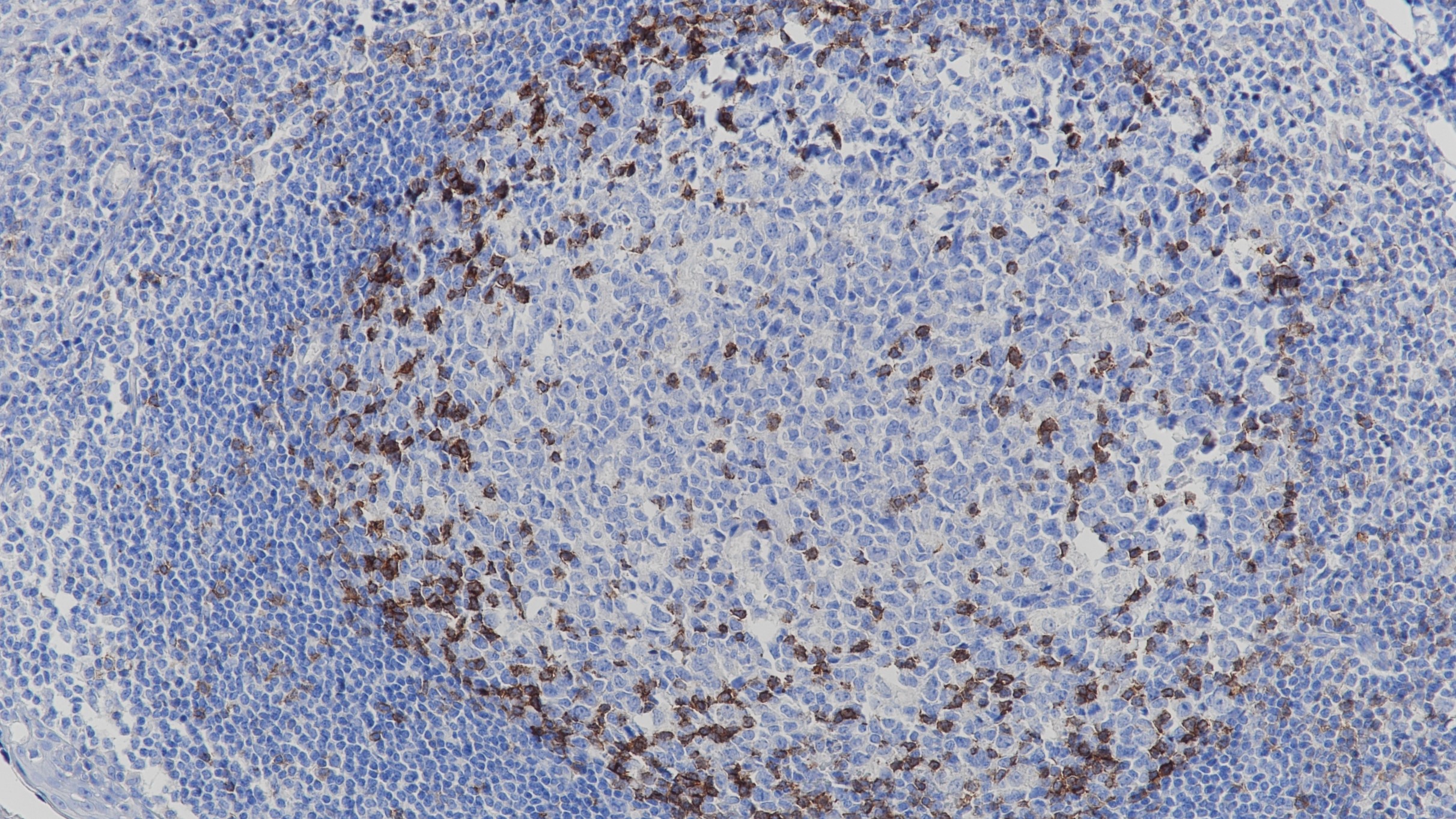 扁桃体PD-1(BP6003) 染色