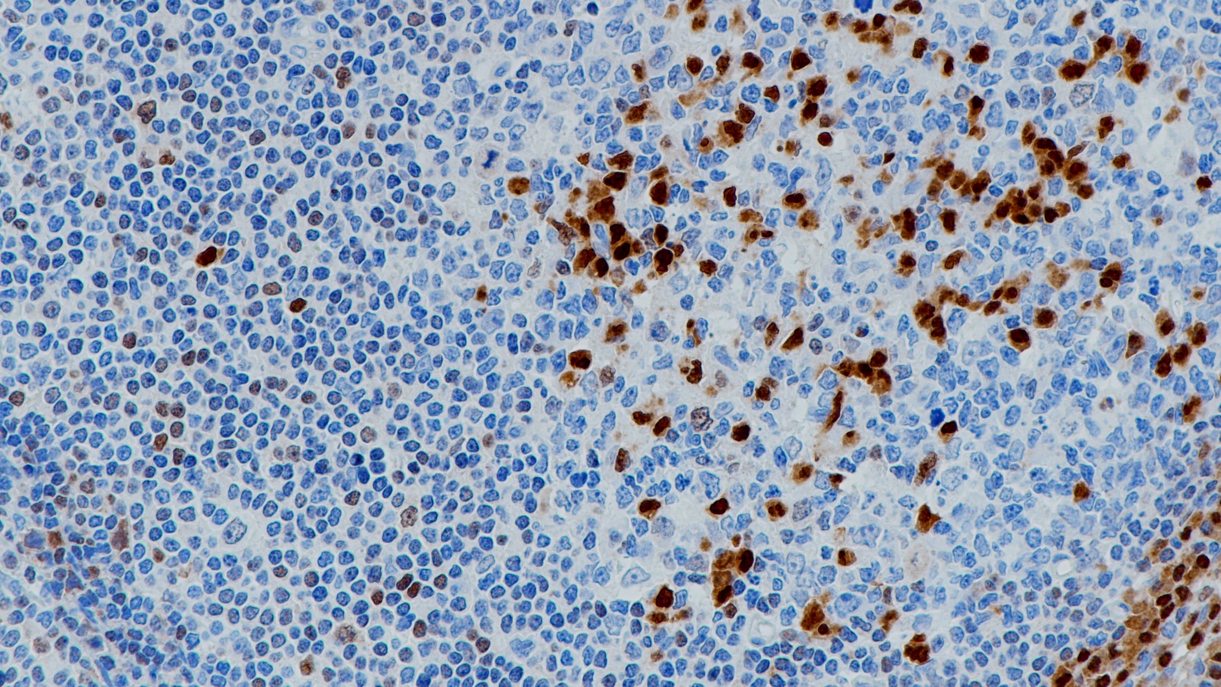 扁桃体MUM1(BP6094)染色