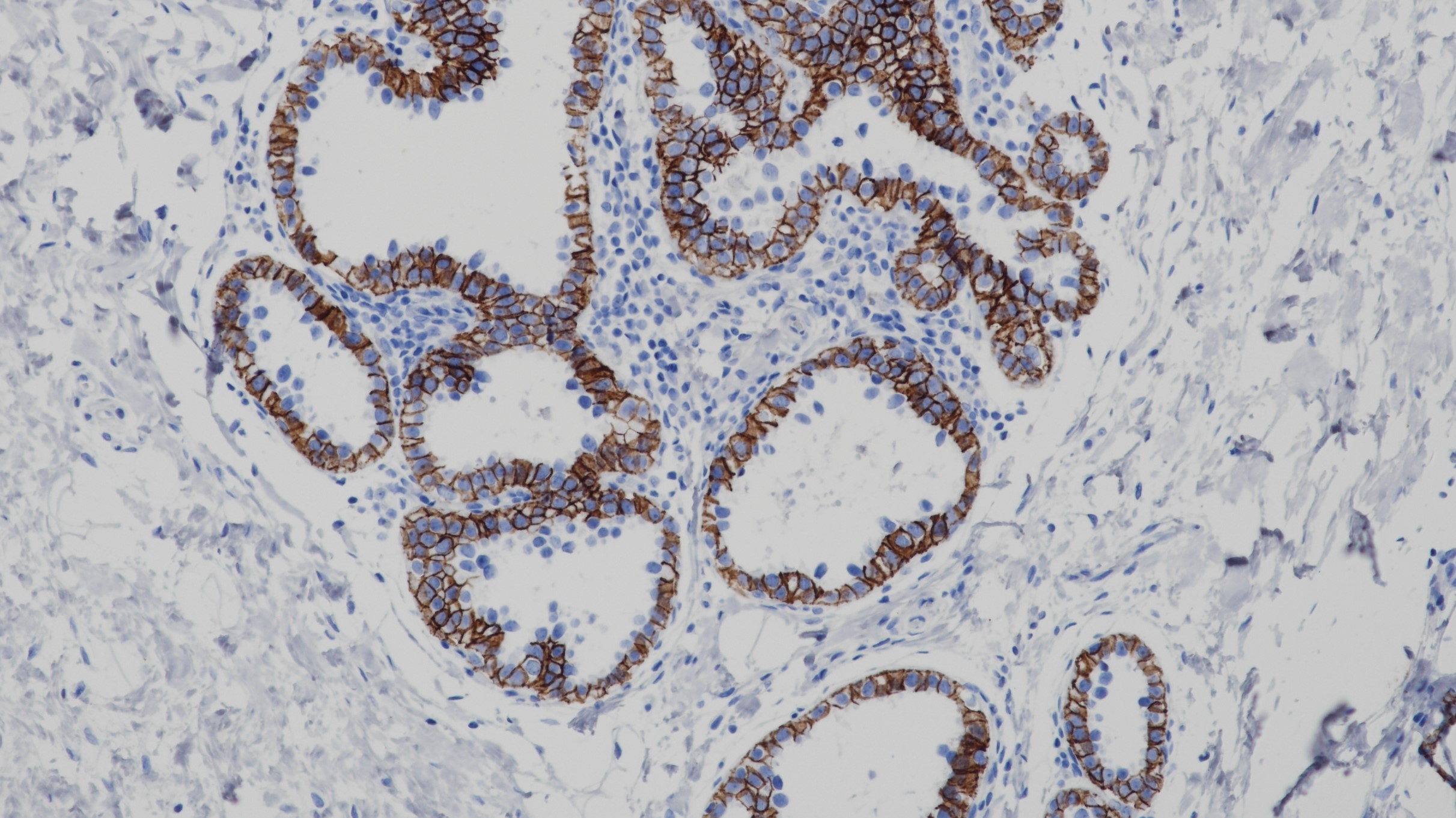 乳腺p120(BP6075)染色