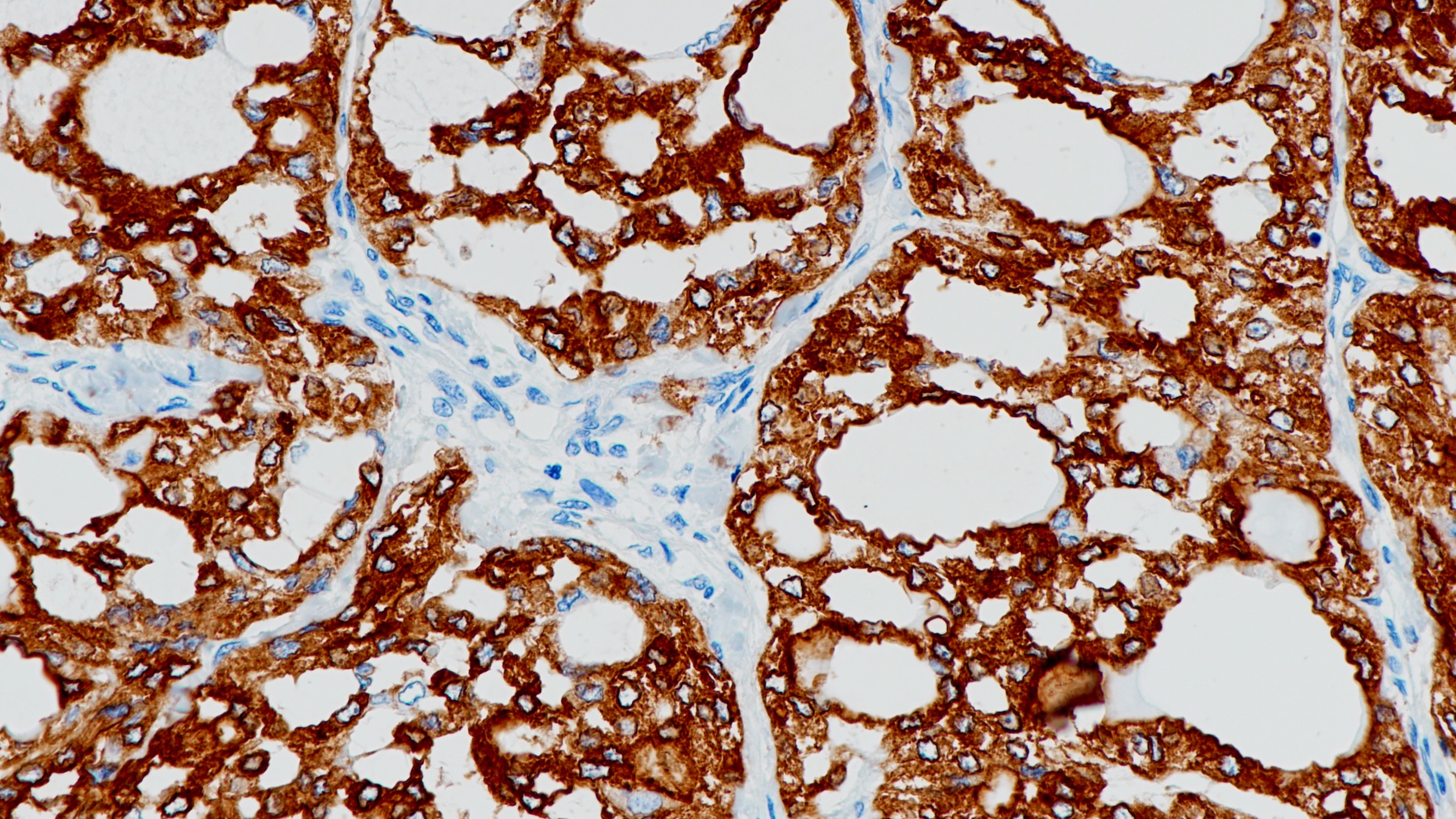 甲状腺癌TPO(BP6071)染色