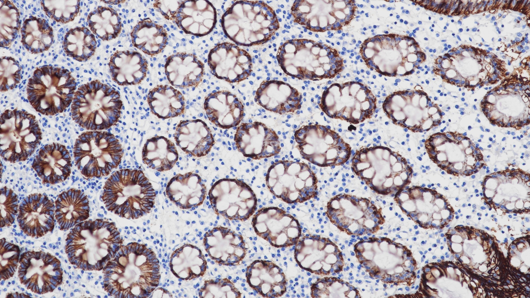 结肠Ep-CAM(BP6056)染色