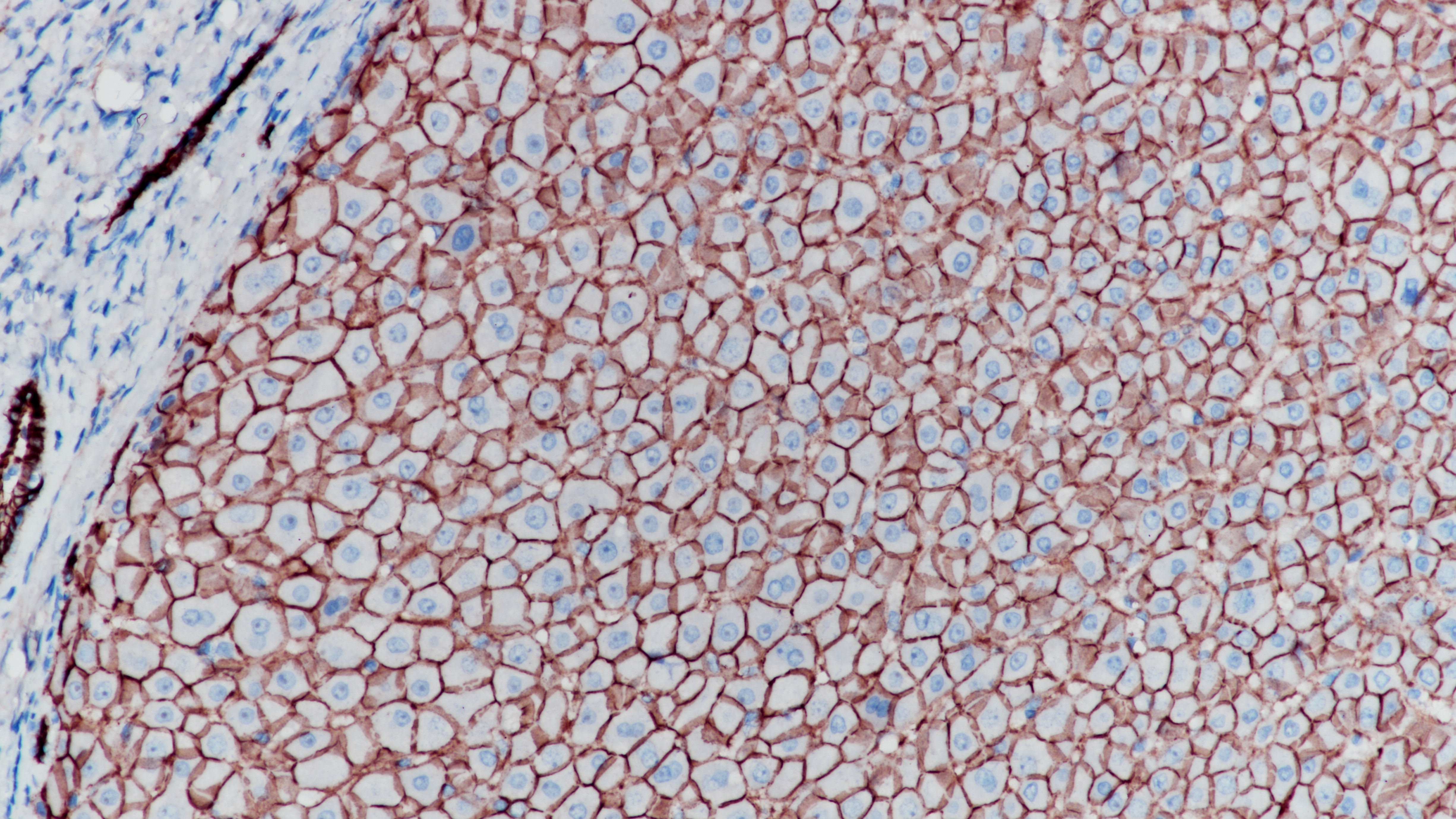 肝E-Cadherin(BP6048)染色