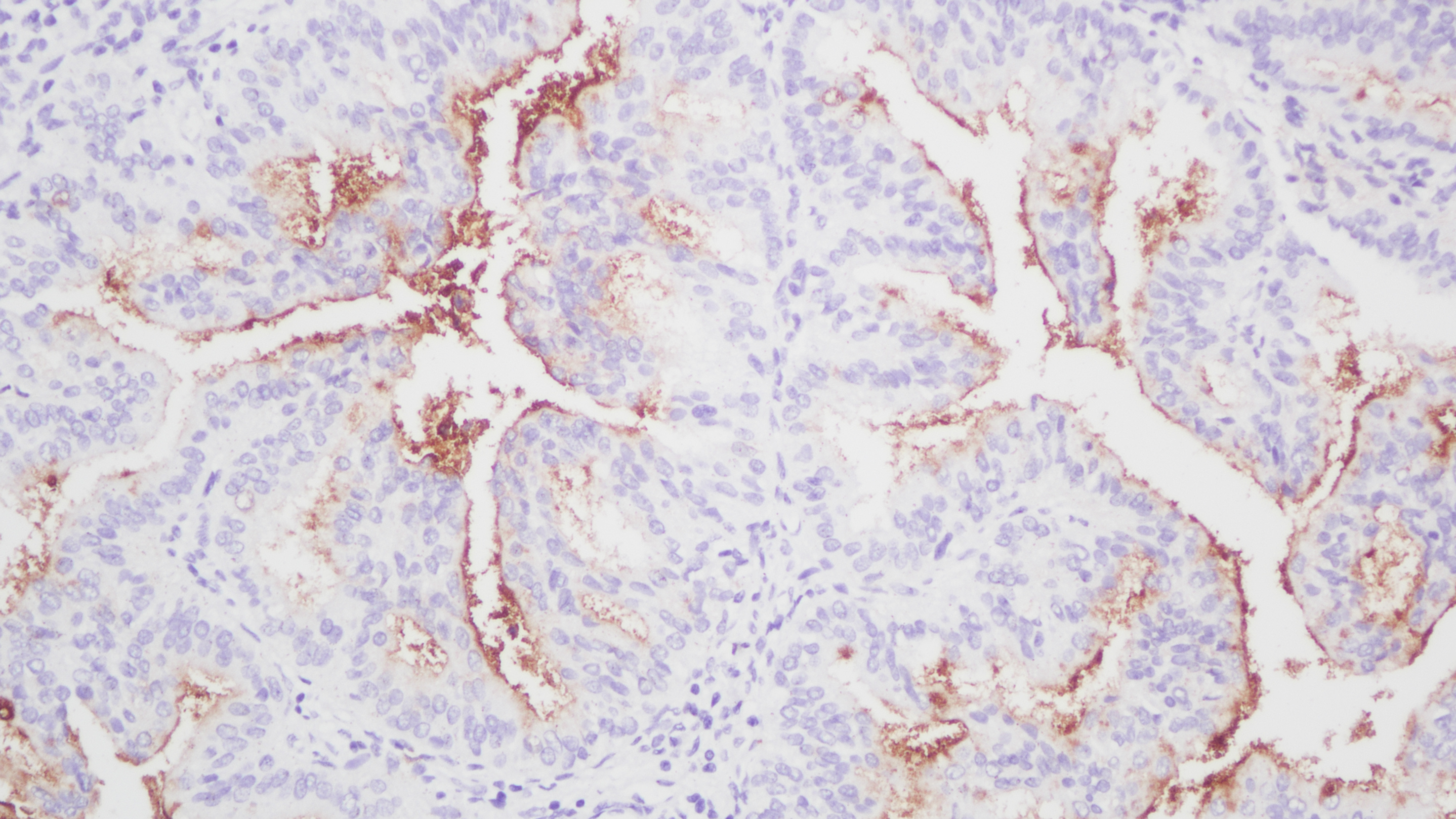子宫内膜癌CA125(BP6014)染色