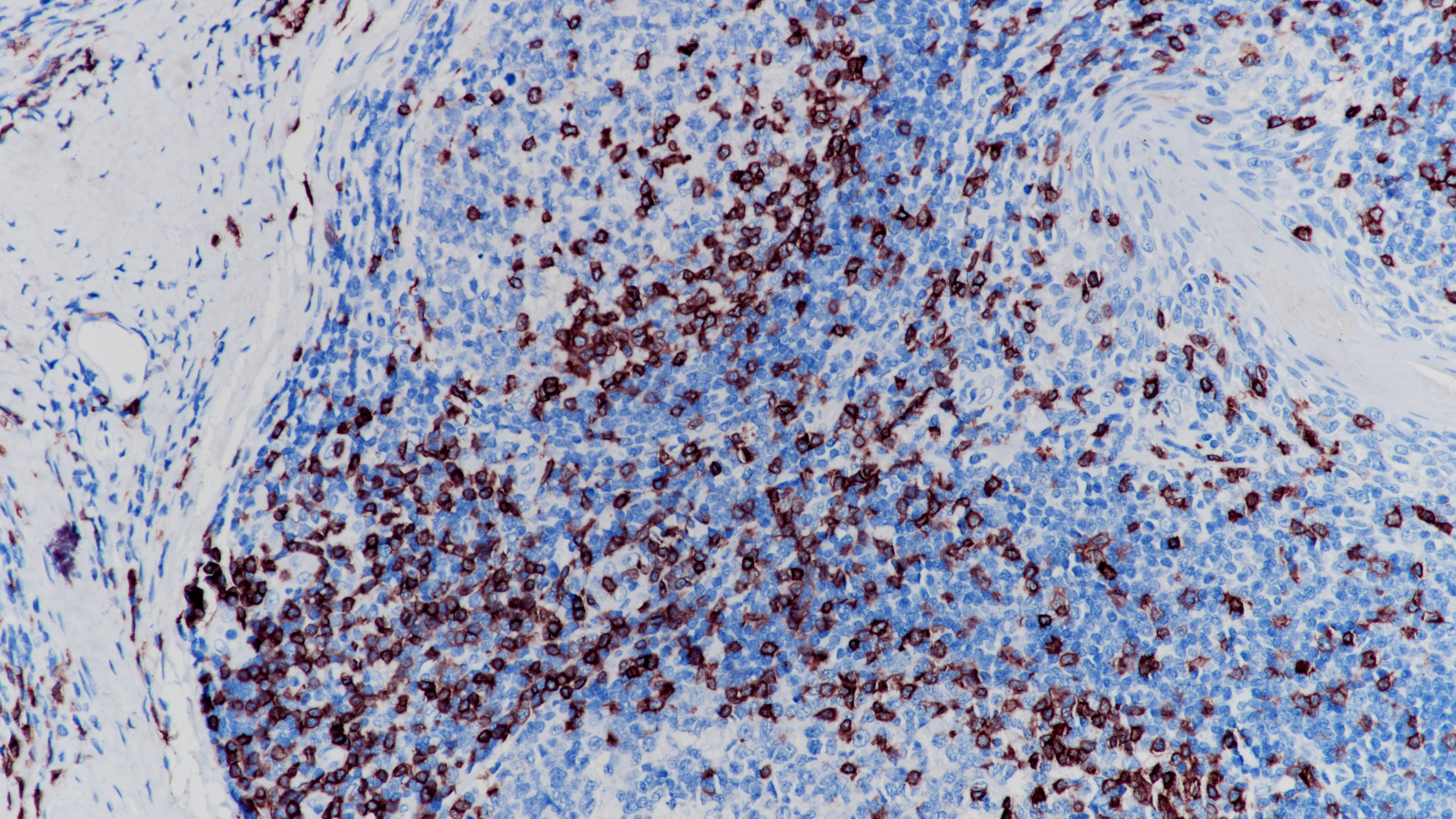 扁桃体CD3(BP6039)染色