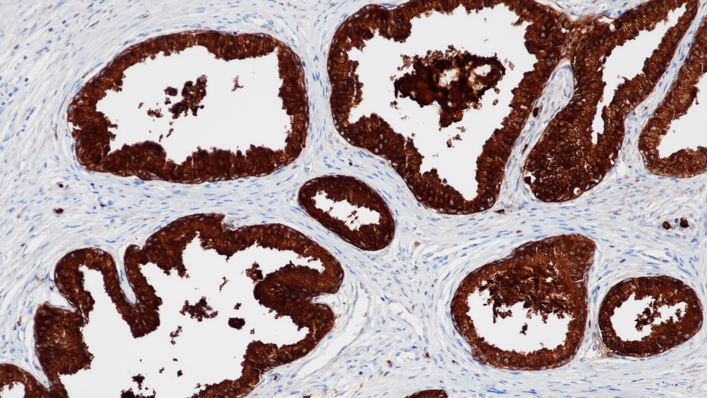 前列腺PSA(BP6043)染色