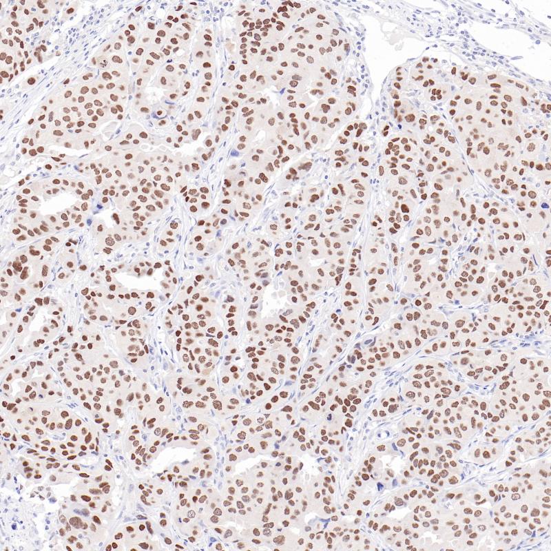 乳腺癌TRPS1(BP6231)染色