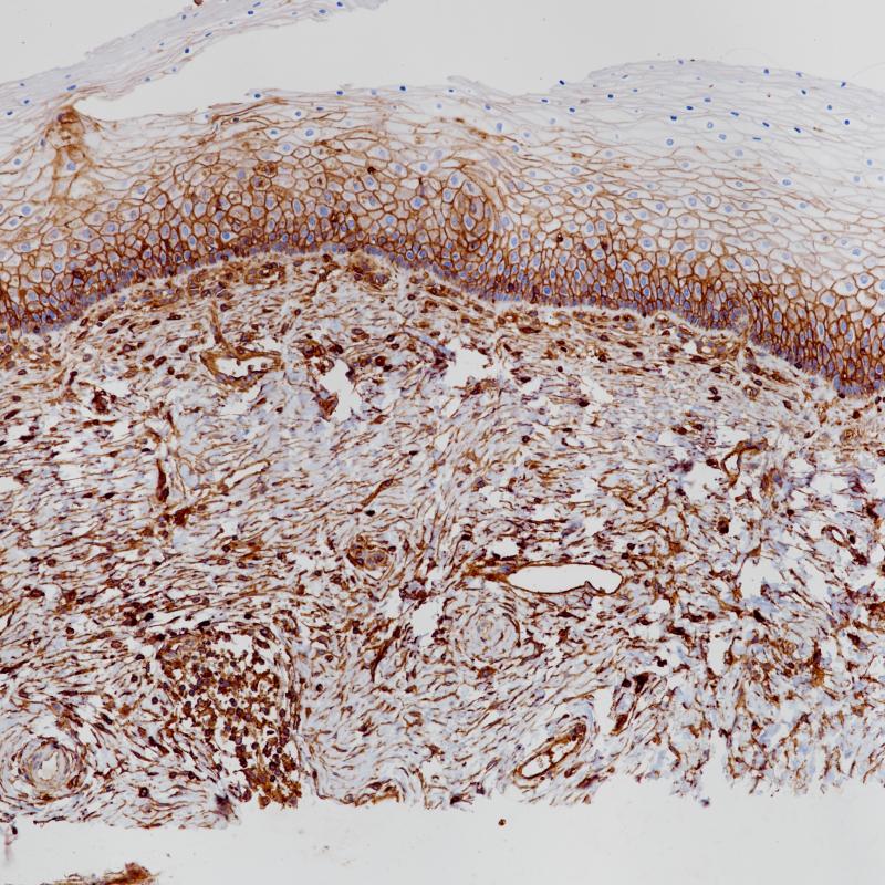 宫颈MHCⅠ(BP6234)染色