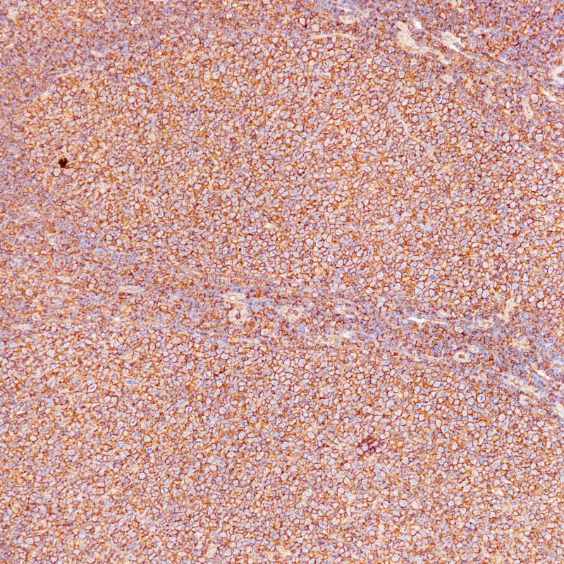 扁桃体MHCⅠ(BP6234)染色