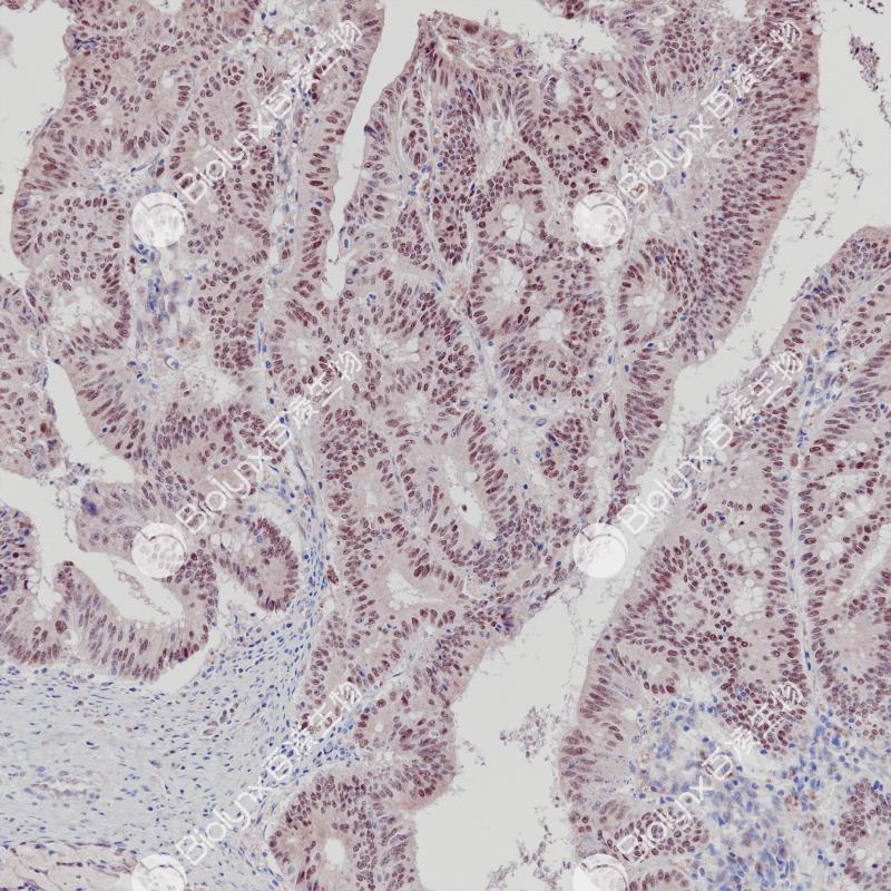 结肠癌c-Myc（BP6258）染色