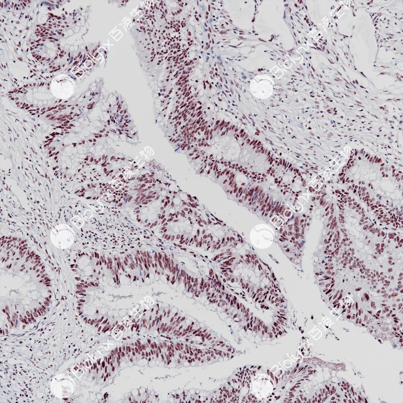 结肠癌BAP-1（BP6255）染色