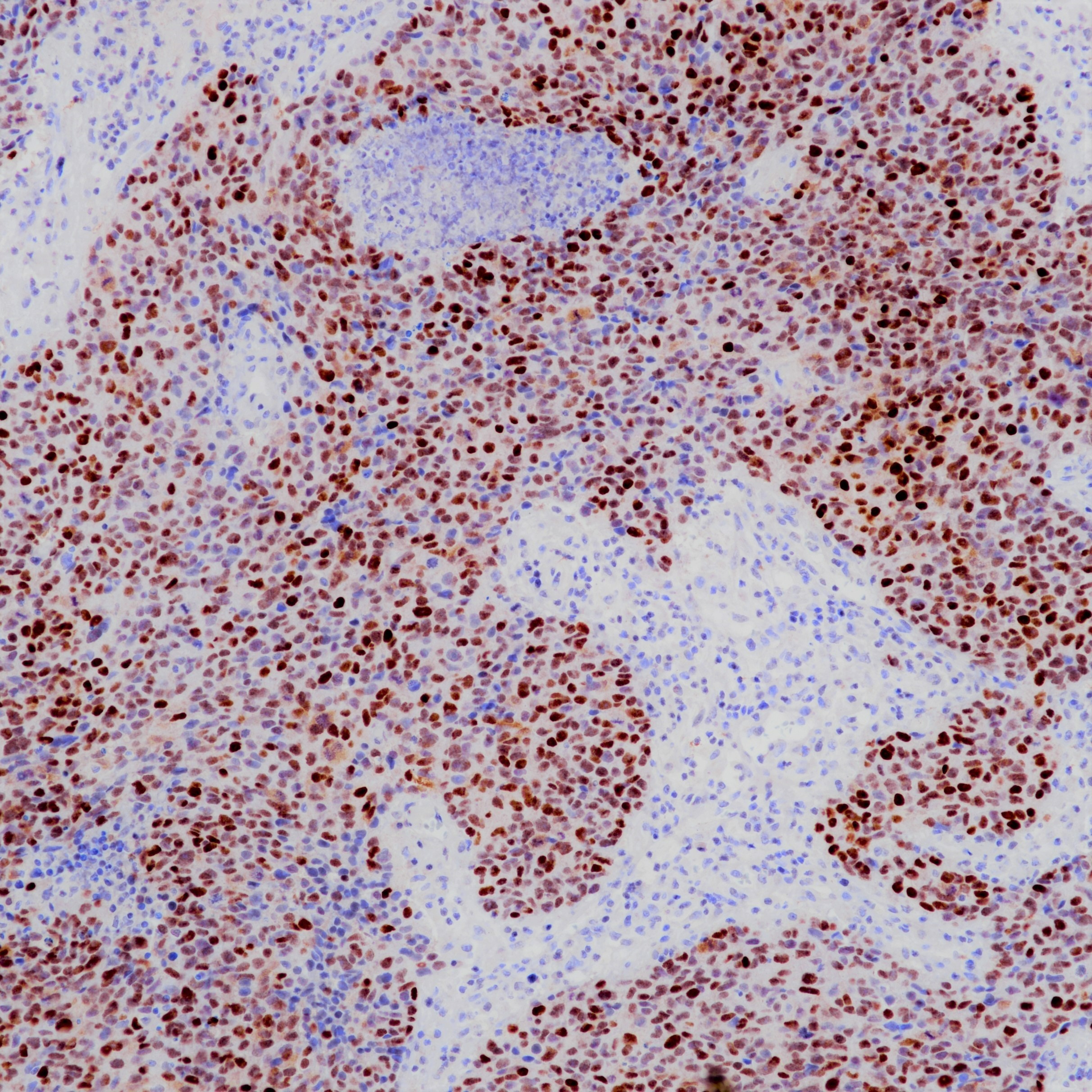 鼻咽癌EBER探针染色