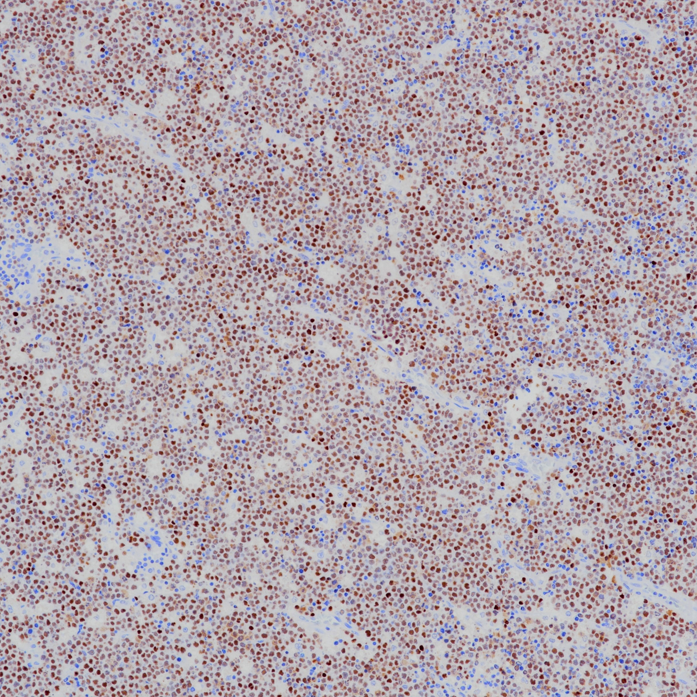 伯基特淋巴瘤EBER染色