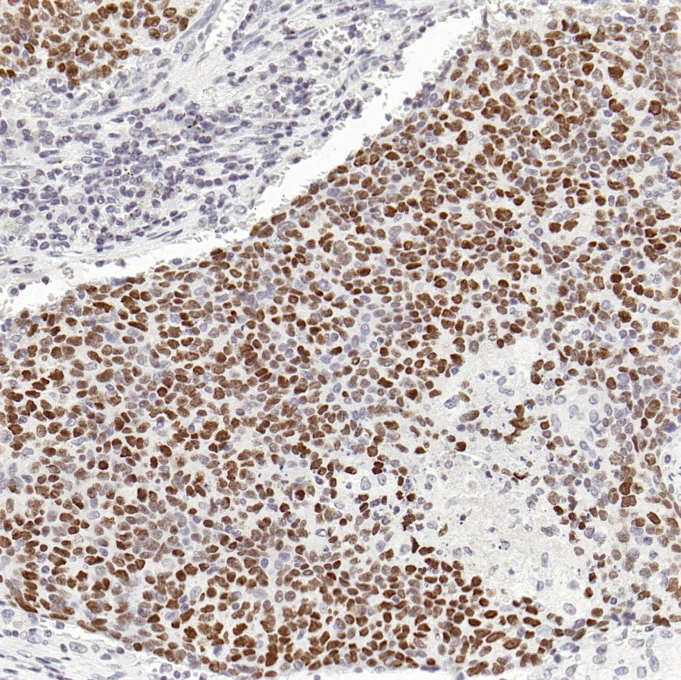 肺癌EBER探针染色