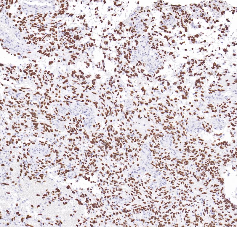 突变型弥漫性中线胶质瘤H3K27M（BP6294）染色