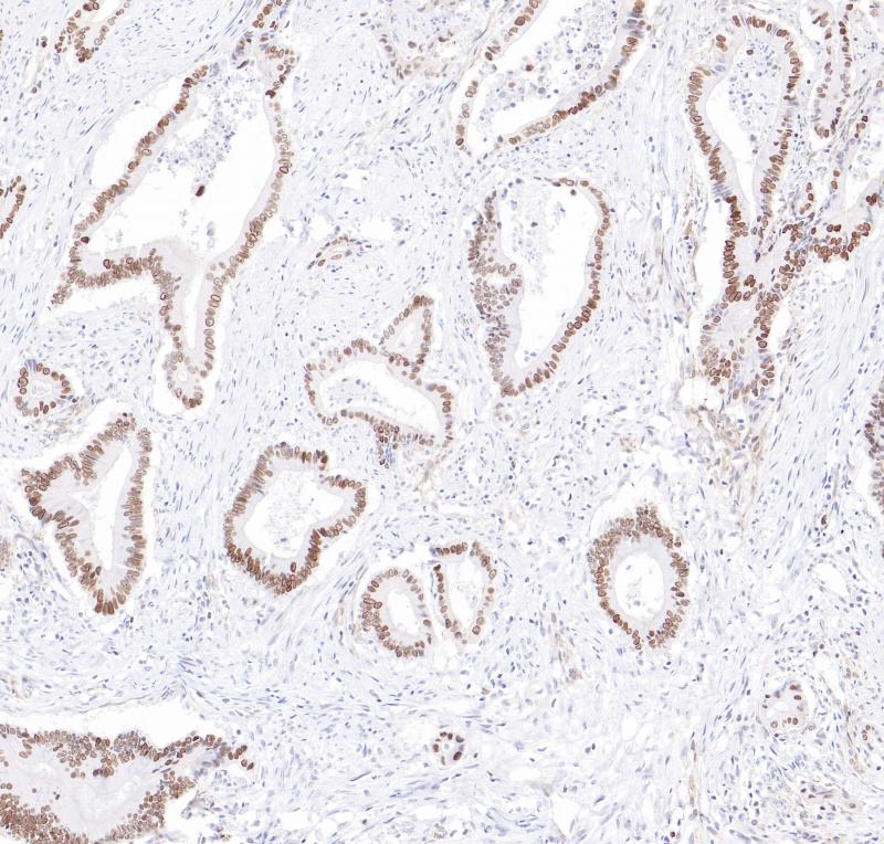 结肠癌OVOL2（BP6285）染色