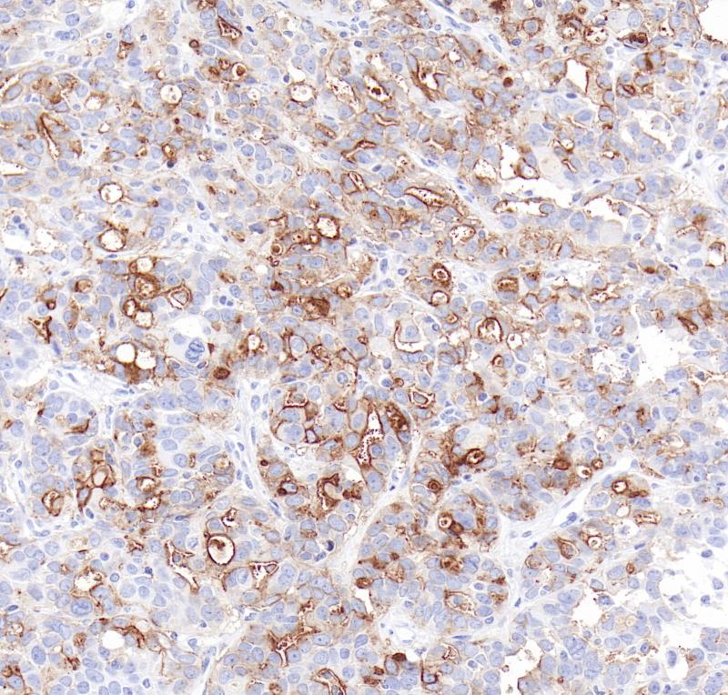 卵巢癌FRα（BP6286）染色