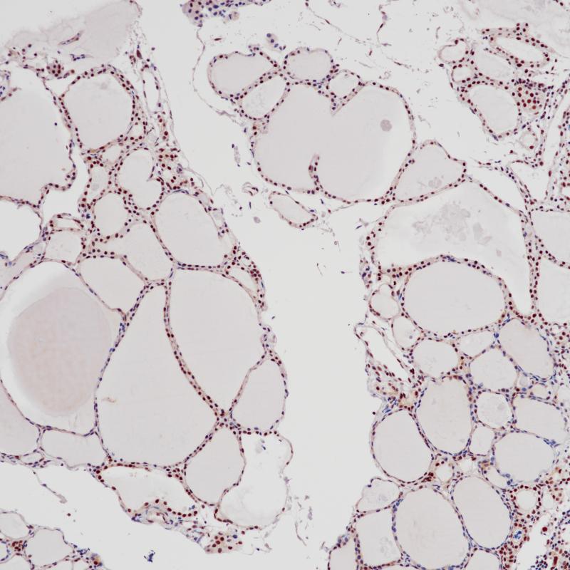甲状腺Parafibromin（BX6288）染色