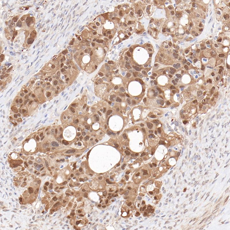 卵巢癌GST-π（GST-π）染色