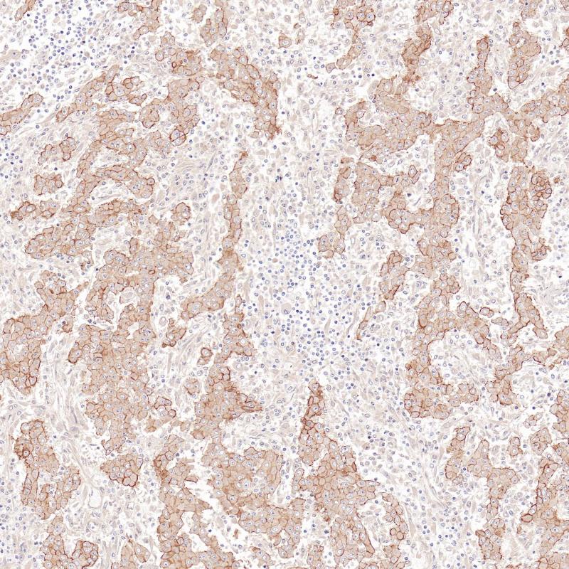 间皮瘤Mesothelin（BP6302）染色