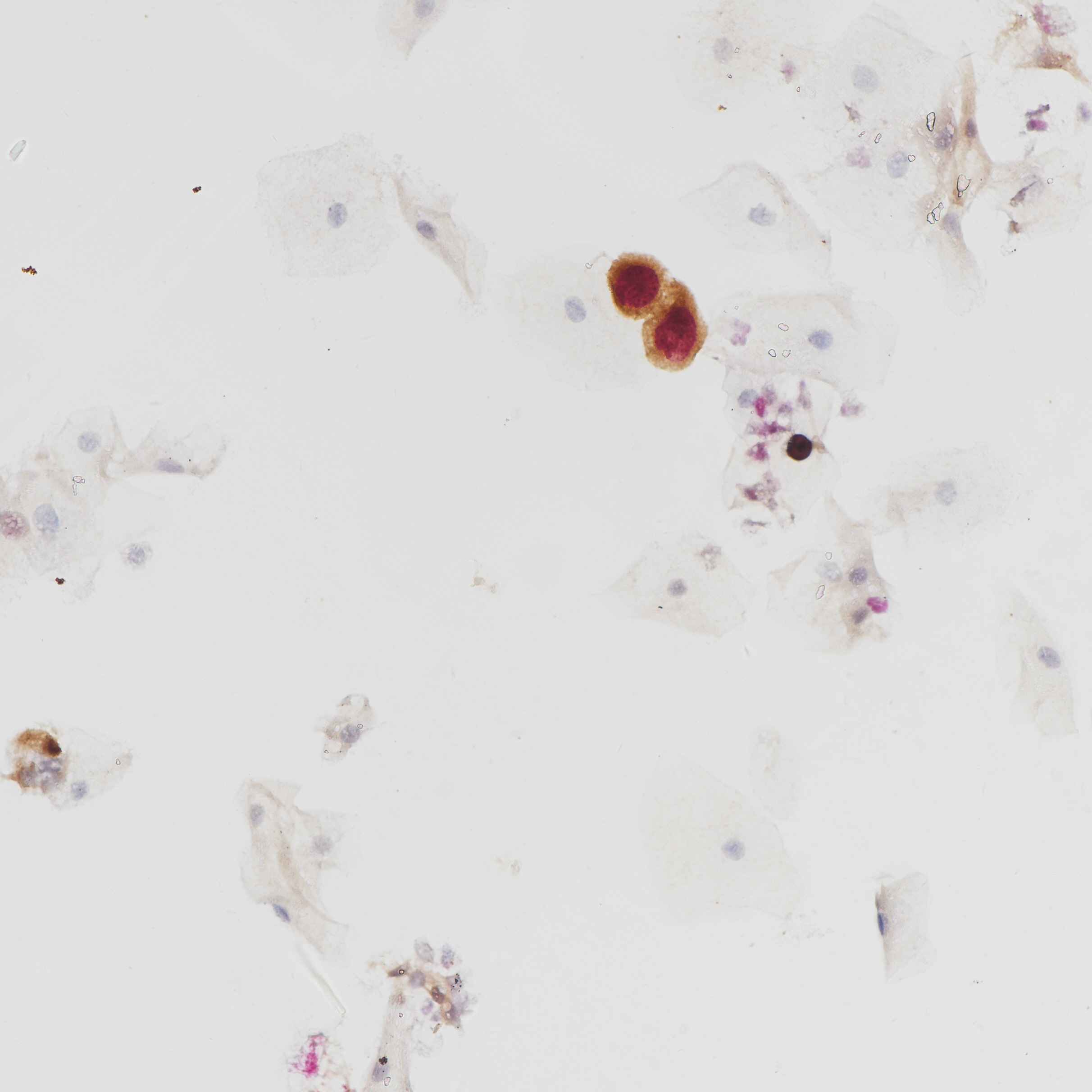 液基细胞学样本双染阳性
(p16/Ki-67同时阳性)40倍镜