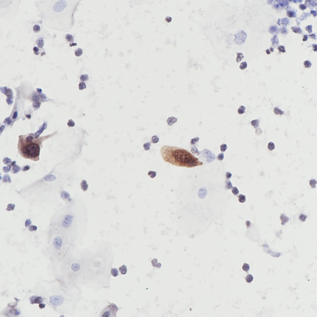液基细胞学样本双染阴性
(仅p16单阳) 40倍镜