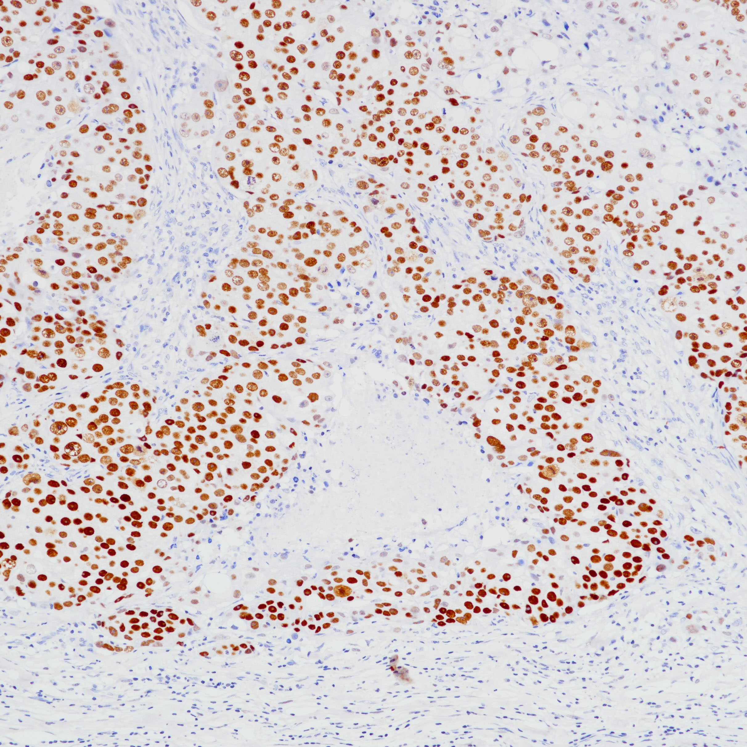 三阴性乳腺癌TRPS1(BP6231)染色