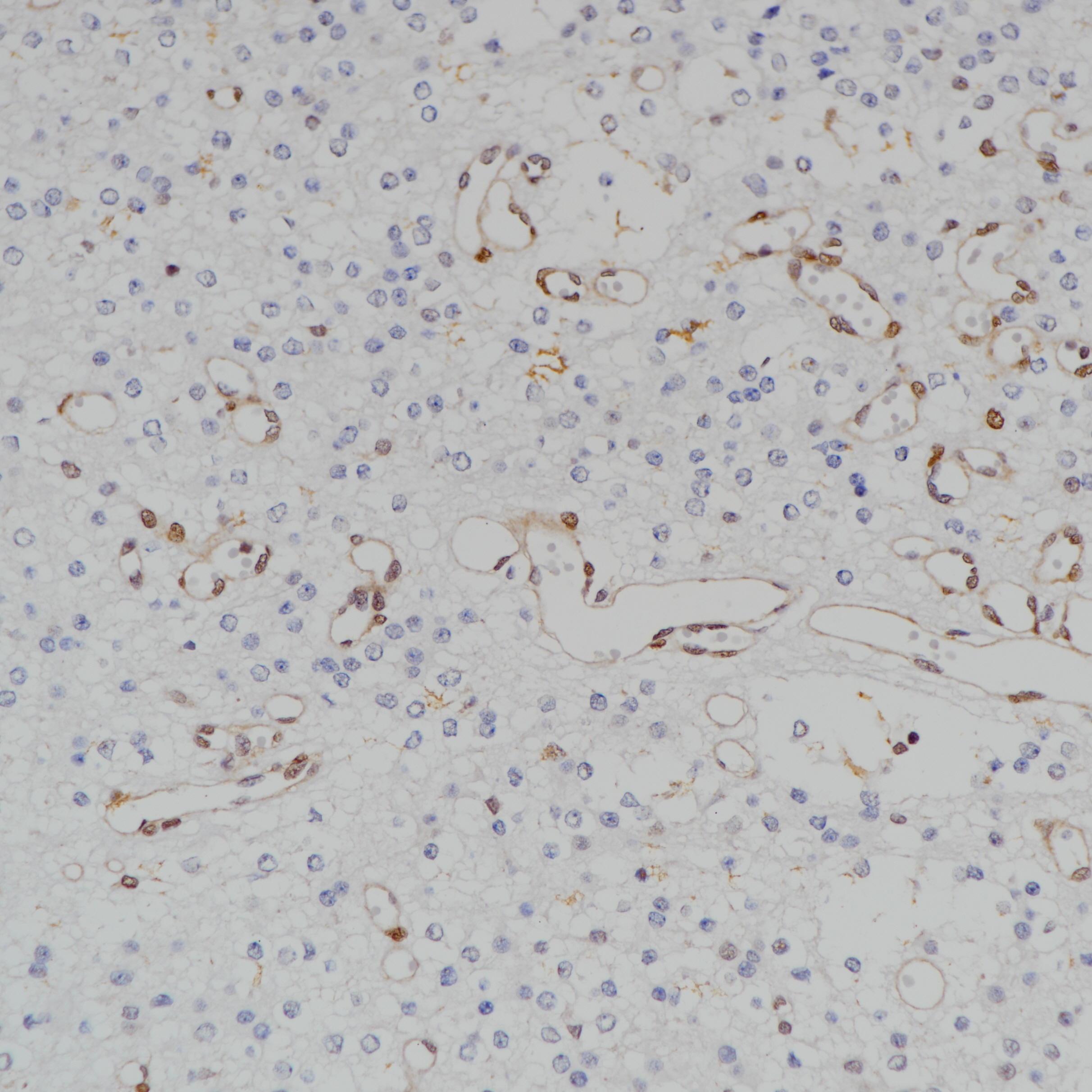 胶质瘤 MGMT(BP6217)染色