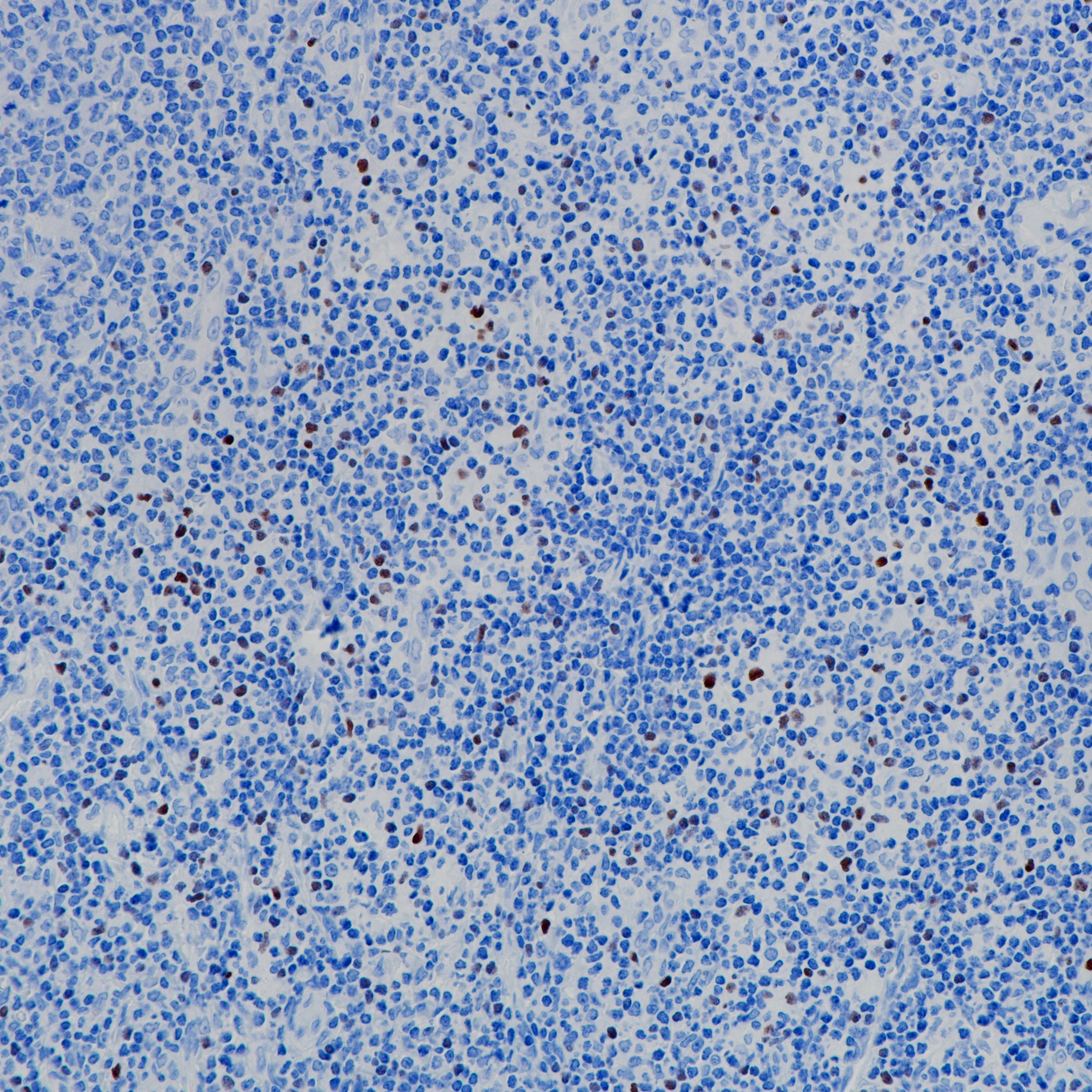 扁桃体 FoxP3（BP6166）染色