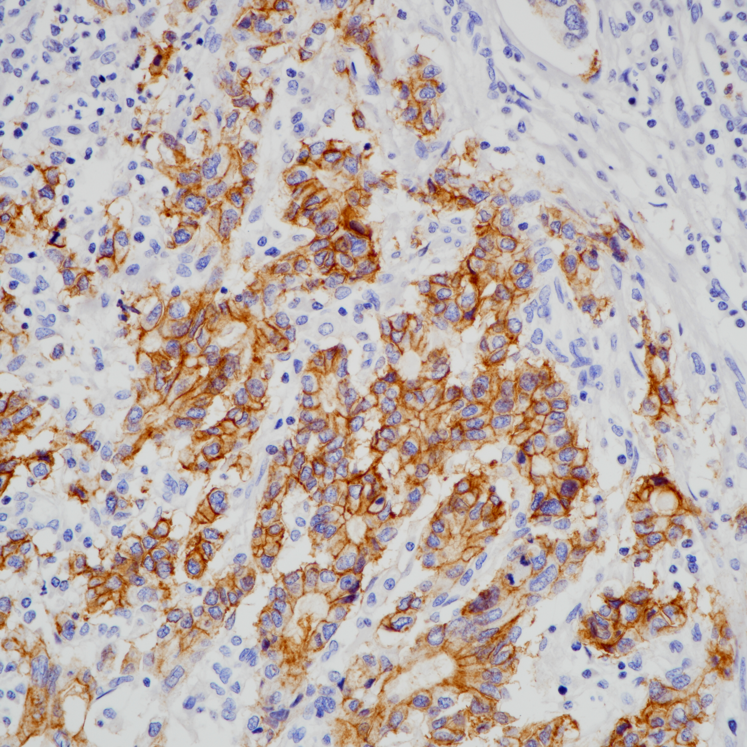 胃癌CLDN18.2(BP6249)染色