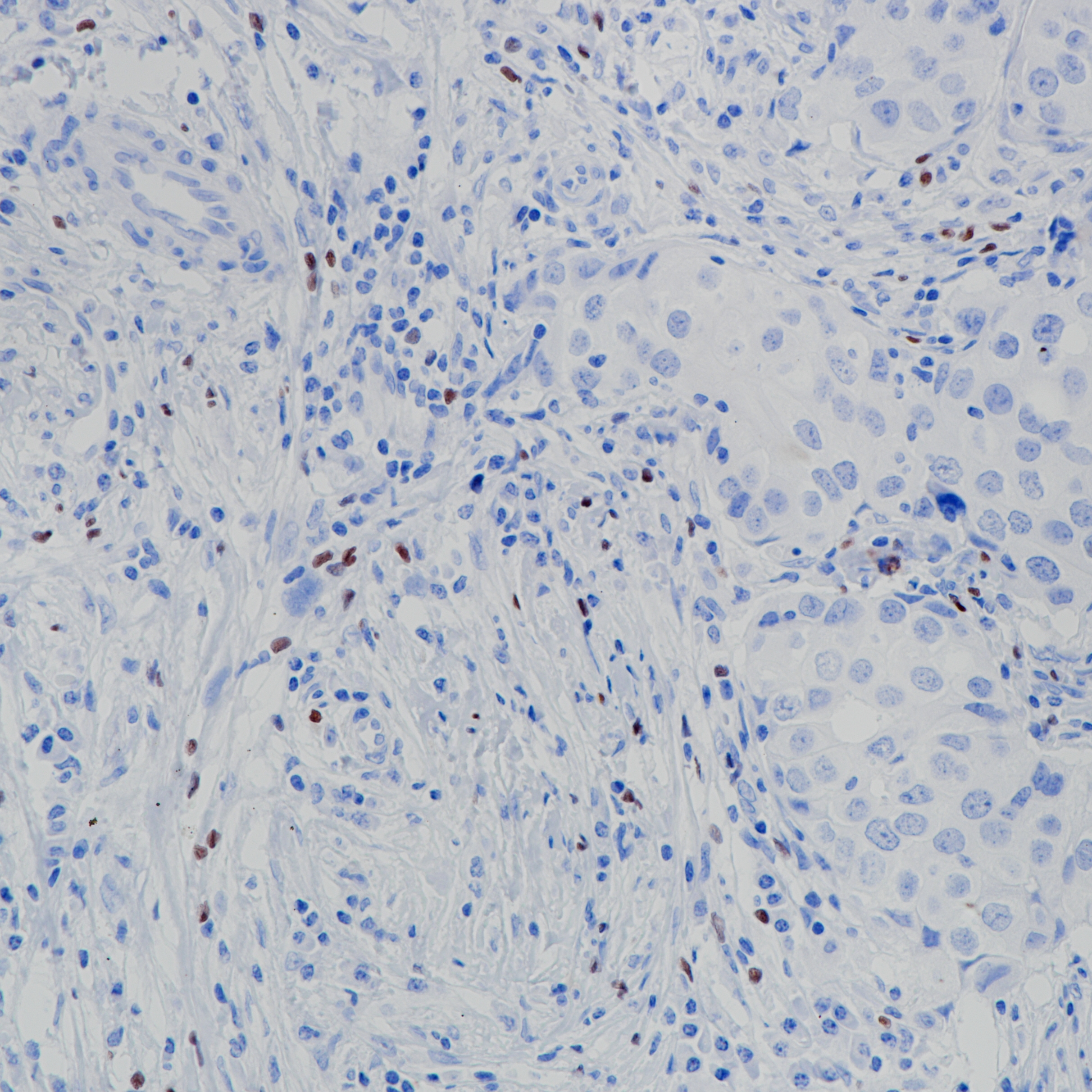 乳腺癌 FoxP3（BP6166）染色