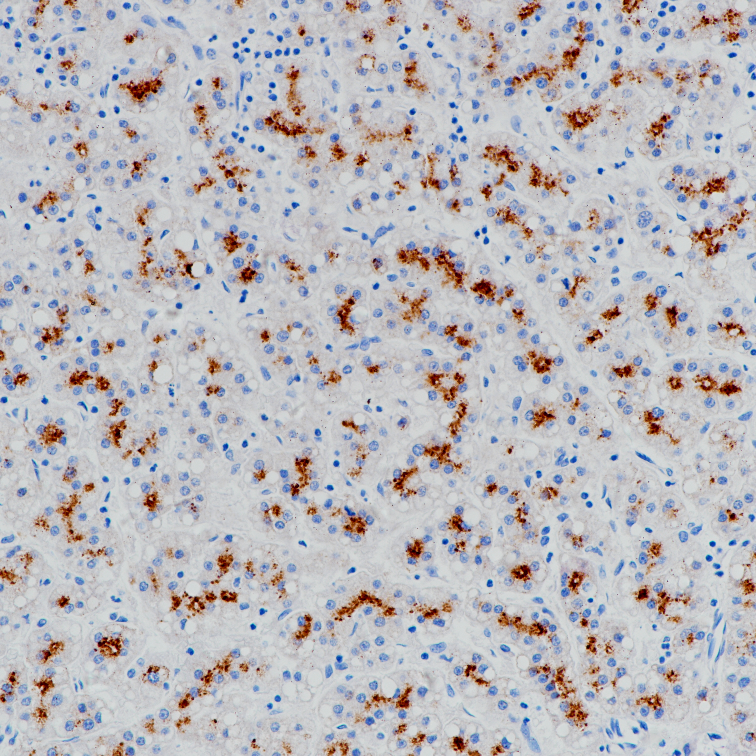 肝癌 GLP3（BP6228）染色