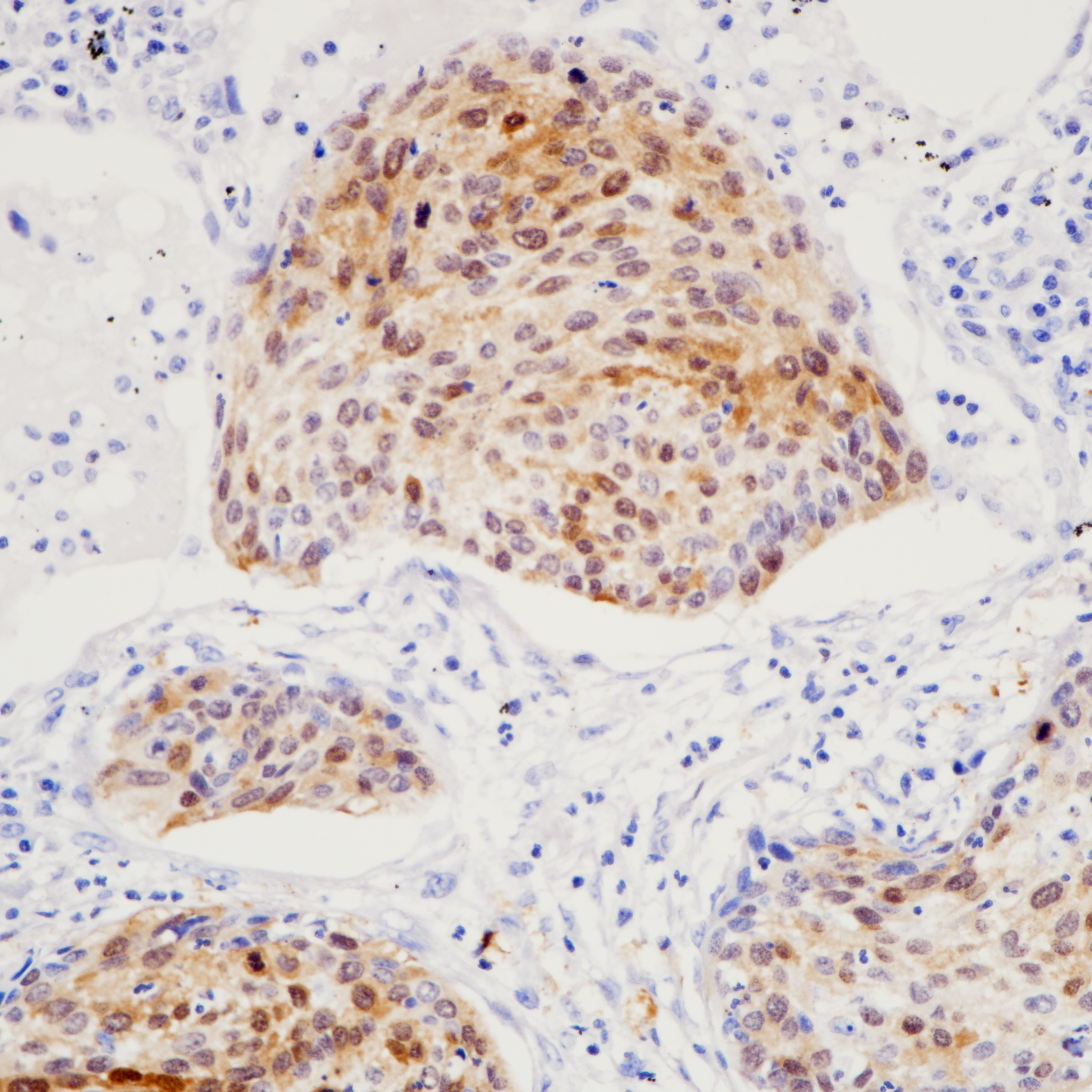 肺小细胞癌 Stathmin(BP6241)染色