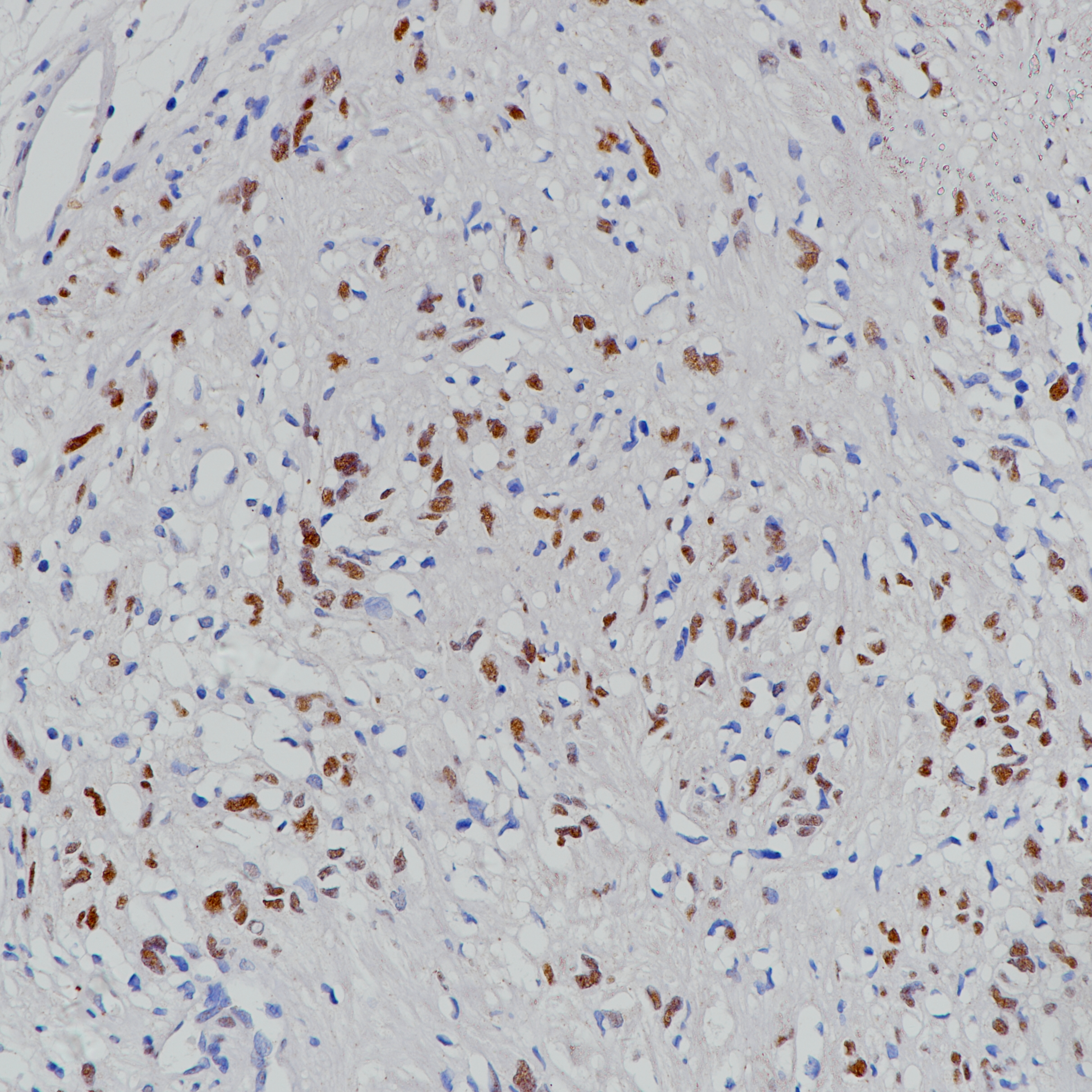 神经鞘瘤 TLE1(BP6223)染色