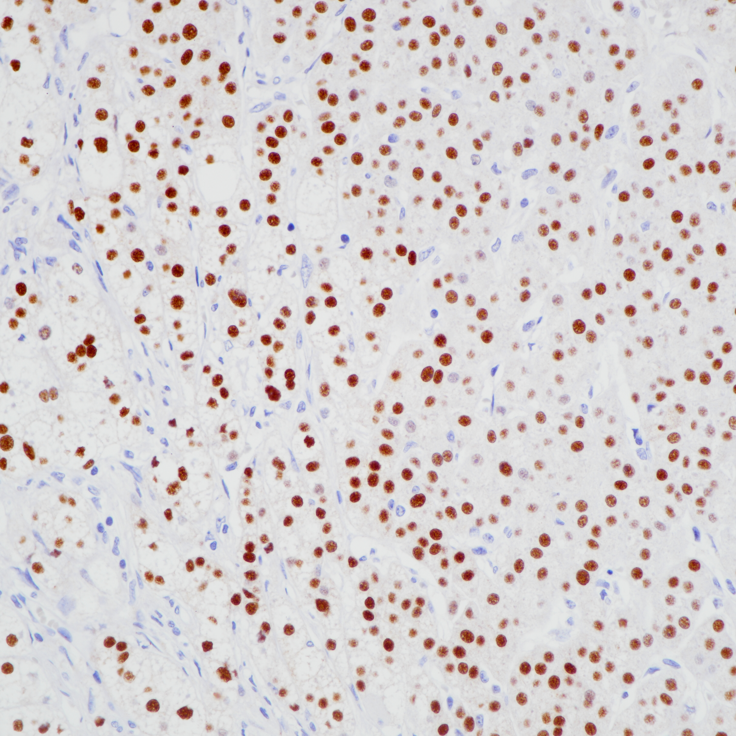 肾上腺皮质瘤 SF-1（BP6236）染色