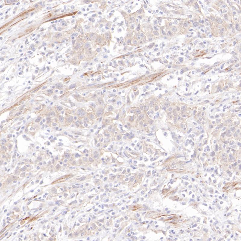 食管癌IL-11RA（BP6315）染色