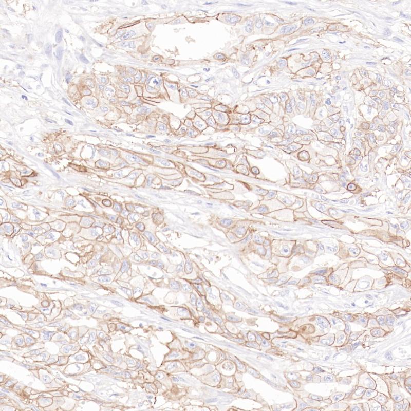 胃癌CD155(BP6339)染色